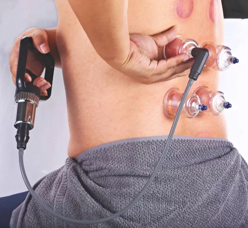 ACUTOP Műanyag Köpölykészlet Tűz Nélkül Használható, Vákumpumpával, 19 db-os